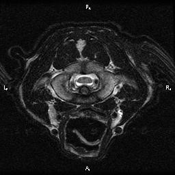 MRI foramen magnum 1