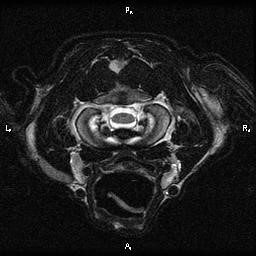 MRI foramen magnum 2