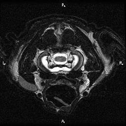MRI foramen magnum 3