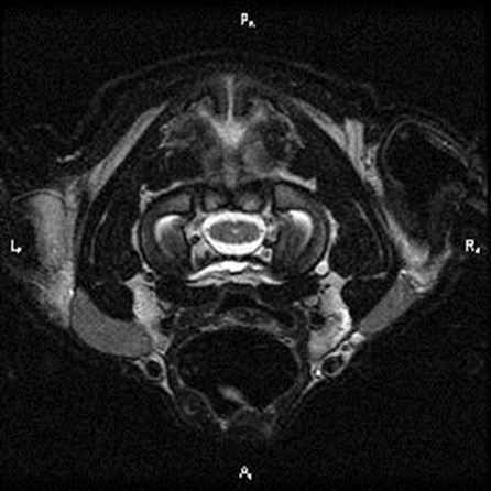 MRI foramen magnum 4