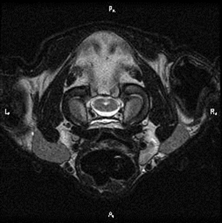 MRI foramen magnum 5