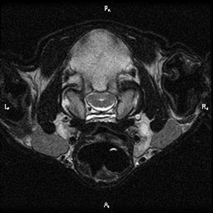 MRI foramen magnum 6