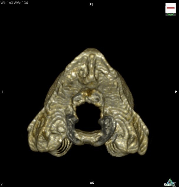 3d_ct_caudal_view_of_an_affected_lion_after_decompression_surgery